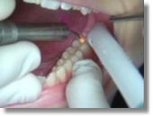   Лечение при зубной боли